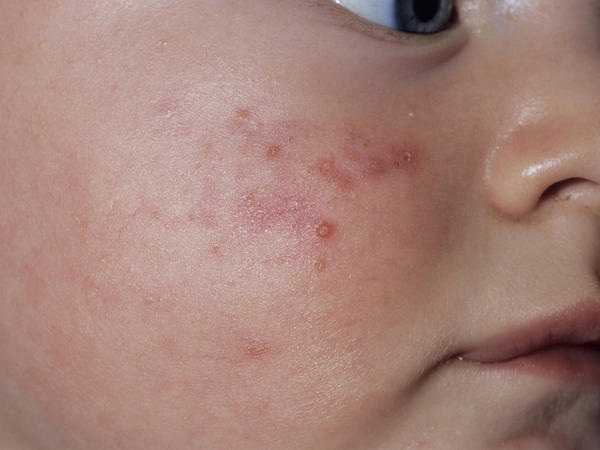 Things You Should Know About Facial Ringworm Just Ask Medical