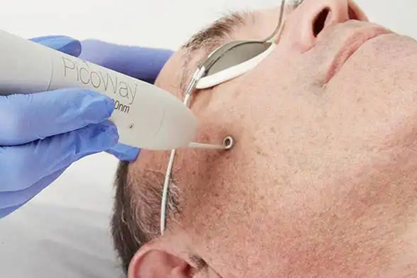 Singapore's Pico Laser treatment